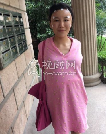 上海新华医院马晓荣脂肪填充太阳穴额头泪沟