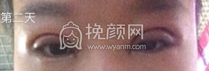 长沙伊美刘芳医生切开双眼皮