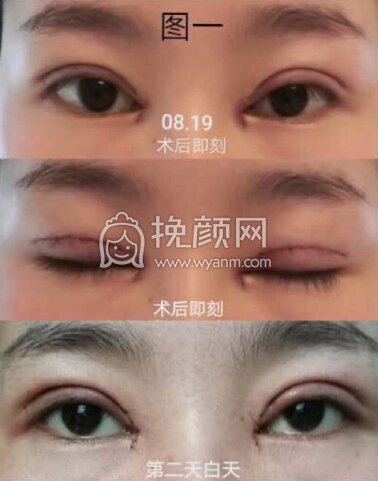 成都良好美妍的徐彬做的全切+内眼角+提肌