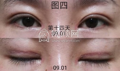 成都良好美妍的徐彬做的全切+内眼角+提肌