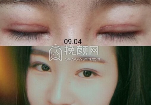 成都良好美妍的徐彬做的全切+内眼角+提肌