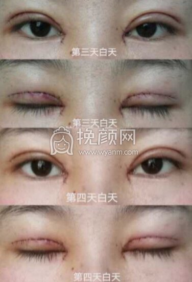 成都良好美妍的徐彬做的全切+内眼角+提肌