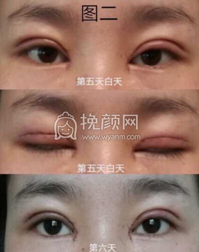成都良好美妍的徐彬做的全切+内眼角+提肌
