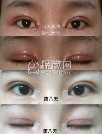 成都良好美妍的徐彬做的全切+内眼角+提肌