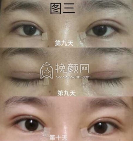 成都良好美妍的徐彬做的全切+内眼角+提肌