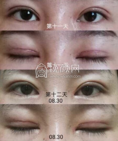 成都良好美妍的徐彬做的全切+内眼角+提肌