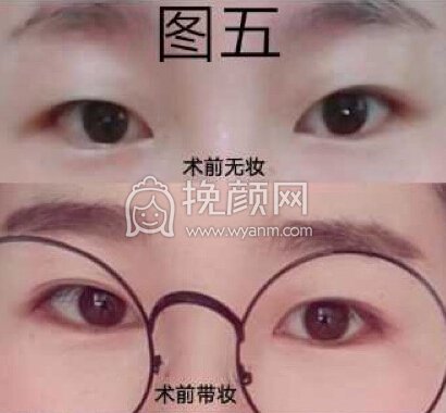 成都良好美妍的徐彬做的全切+内眼角+提肌