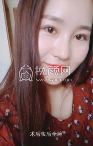 成都良好美妍的徐彬做的全切+内眼角+提肌