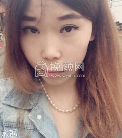 大连李荣喆做的鼻部手术+假体下巴+脂肪填充
