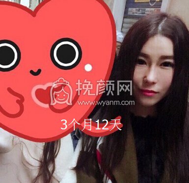 大连李荣喆做的鼻部手术+假体下巴+脂肪填充