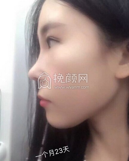 大连李荣喆做的鼻部手术+假体下巴+脂肪填充