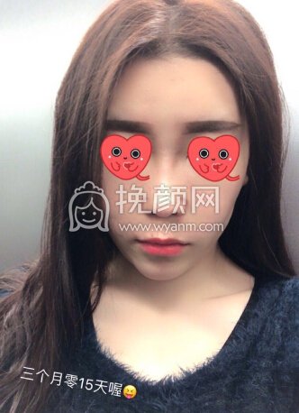 大连李荣喆做的鼻部手术+假体下巴+脂肪填充