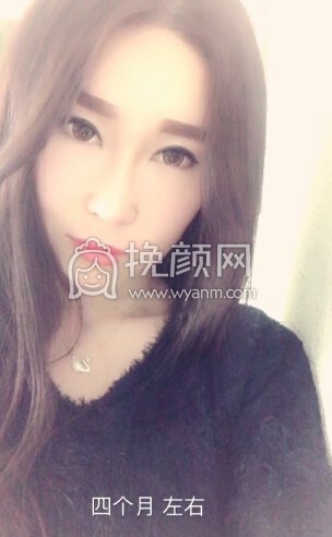 大连李荣喆做的鼻部手术+假体下巴+脂肪填充
