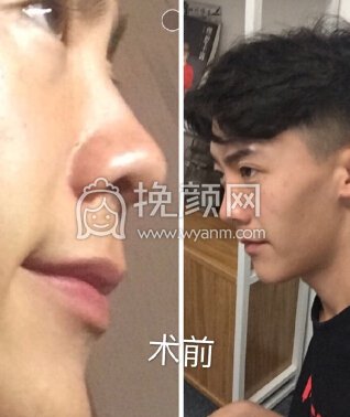 成都铜雀台陈远琨膨体+耳软骨鼻中隔鼻部手术