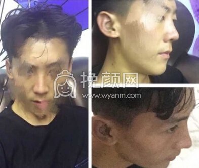 成都铜雀台陈远琨膨体+耳软骨鼻中隔鼻部手术