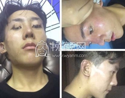 成都铜雀台陈远琨膨体+耳软骨鼻中隔鼻部手术