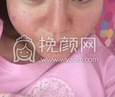 昆明艺星沈婷和尹建兰水光补水，微针，点阵
