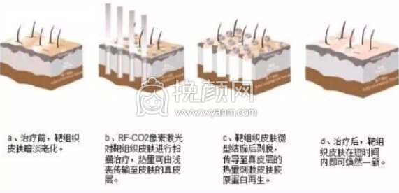 昆明艺星沈婷和尹建兰水光补水，微针，点阵