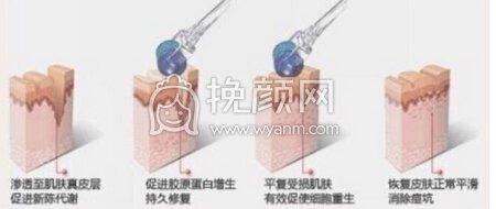 昆明艺星沈婷和尹建兰水光补水，微针，点阵