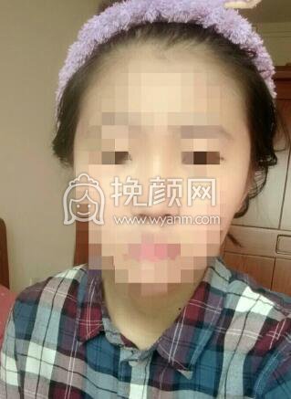 韩式三点+开眼角,价格2000