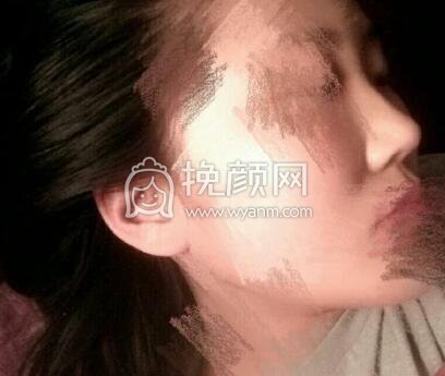 韩式三点+开眼角,价格2000