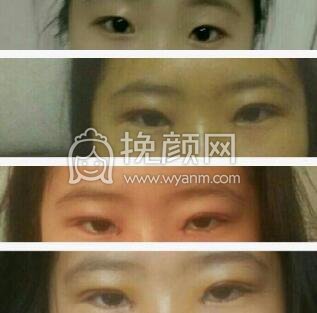 韩式三点+开眼角,价格2000