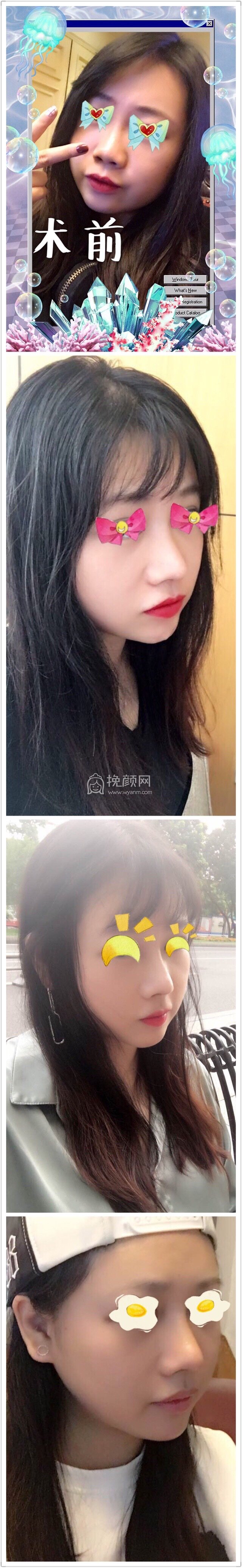 奕后刘俊医生做的双眼皮+鼻部手术手术
