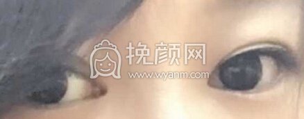 奕后刘俊医生做的双眼皮+鼻部手术手术