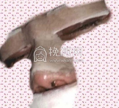 奕后刘俊医生做的双眼皮+鼻部手术手术