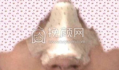 奕后刘俊医生做的双眼皮+鼻部手术手术