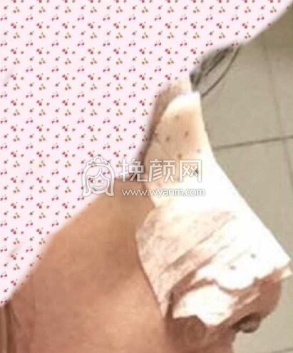 奕后刘俊医生做的双眼皮+鼻部手术手术