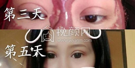 新疆库尔勒金颜医美焦医生双眼皮手术