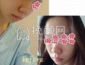 深圳美莱梁晓健院长做的全肋骨鼻部手术