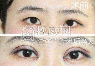 郑州孔宇医生做的双眼皮+开眼角