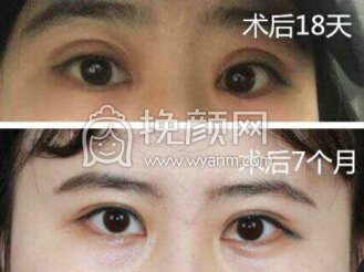 郑州孔宇医生做的双眼皮+开眼角