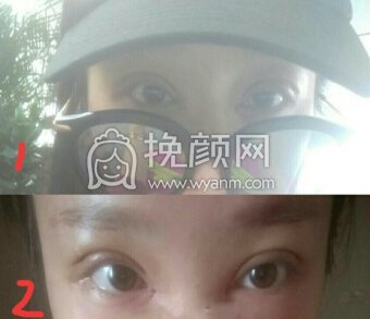 合肥华美医院刚院长内眼角加韩式