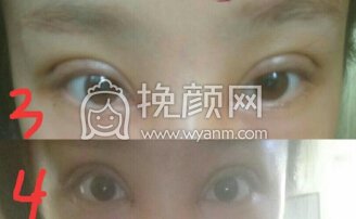 合肥华美医院刚院长内眼角加韩式