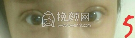 合肥华美医院刚院长内眼角加韩式