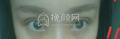 合肥华美医院刚院长内眼角加韩式