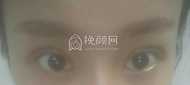 合肥华美医院刚院长内眼角加韩式