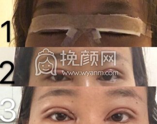 合肥华美朱院长做的双眼皮+开眼角