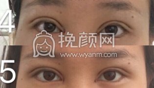 合肥华美朱院长做的双眼皮+开眼角