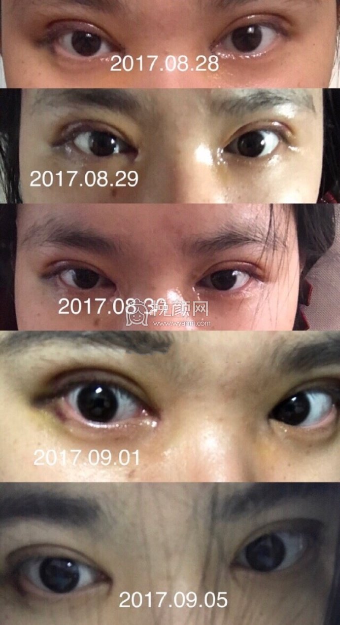 哈尔滨医大一院刁医生一万块做的双眼皮