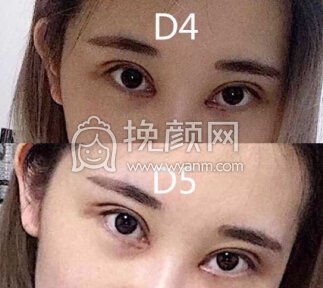 重庆华美整形医院李富强全切双眼皮+开眼角