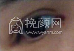 成都三甲医院主任微创双眼皮+开眼角+提肌