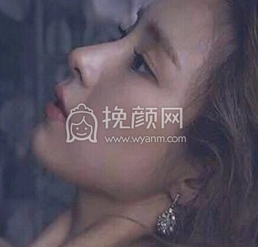 湘雅附二王先成半肋鼻部手术