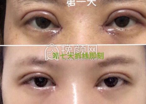 西安刘纲医生做全切双眼皮+开眼角