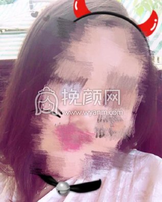 武汉卓美医院王海平教授给做的鼻部手术