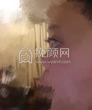 武汉卓美医院王海平教授给做的鼻部手术