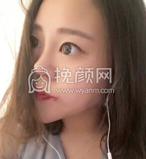 武汉卓美医院王海平教授给做的鼻部手术